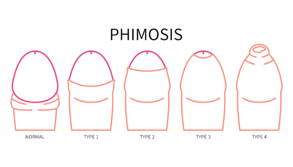 Phimosis grades