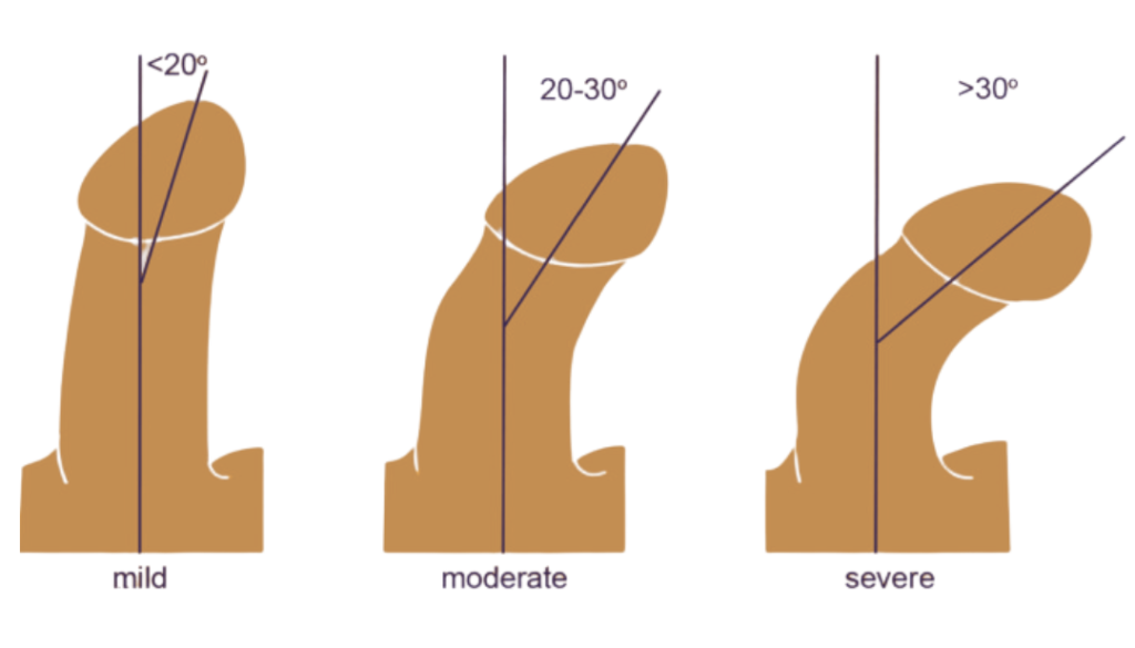 Congenital chordee