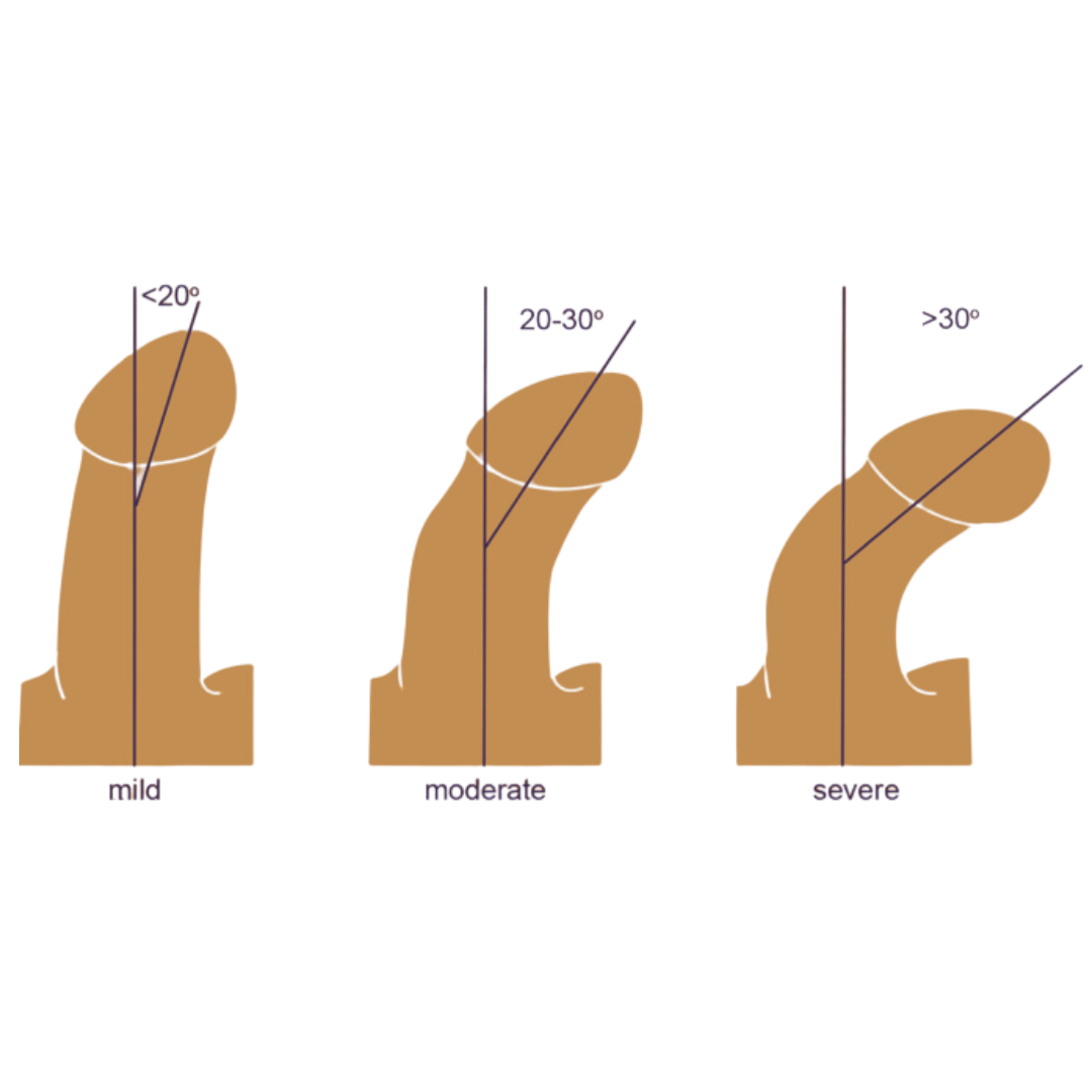 Congenital chordee