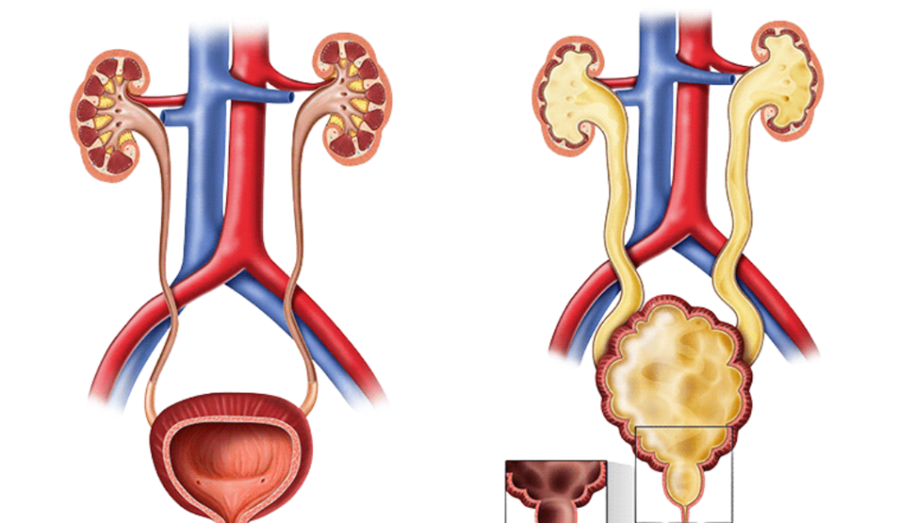 PUV (Posterior Utrethral Valve