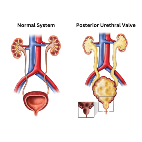 PUV (Posterior Utrethral Valve