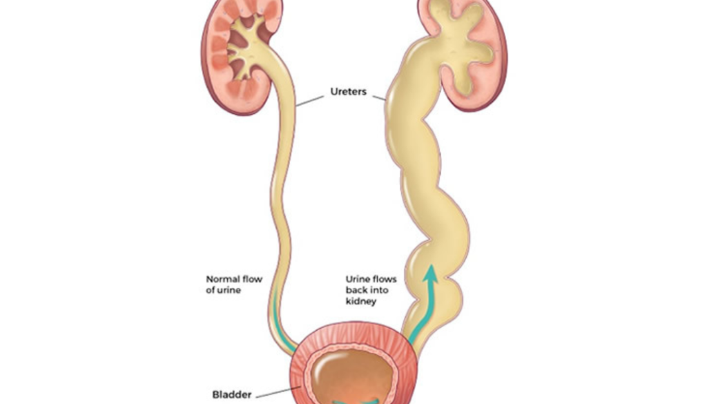 Vesicoutreteric valve obstruction