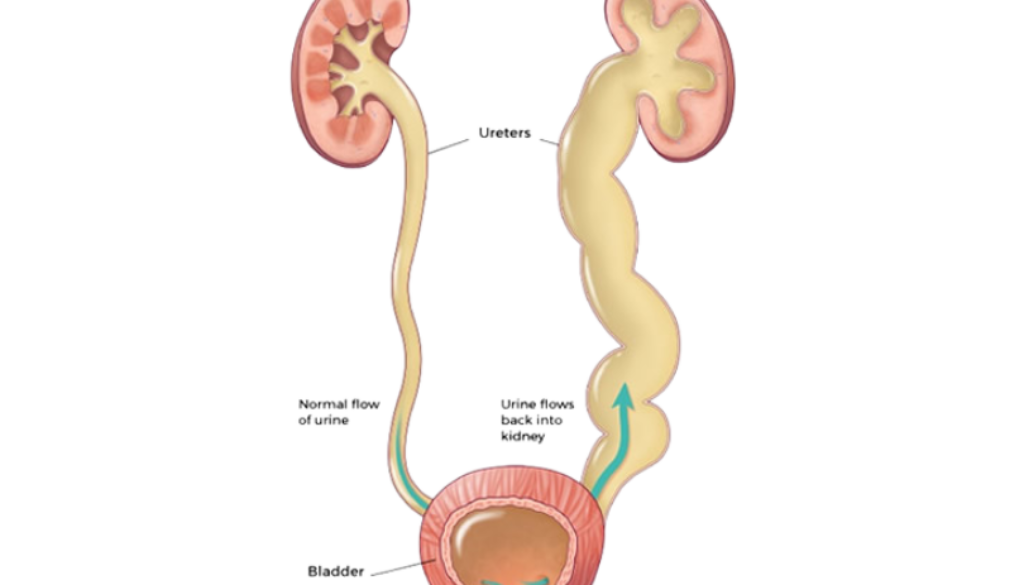 Vesicoureteral Reflux (VUR)