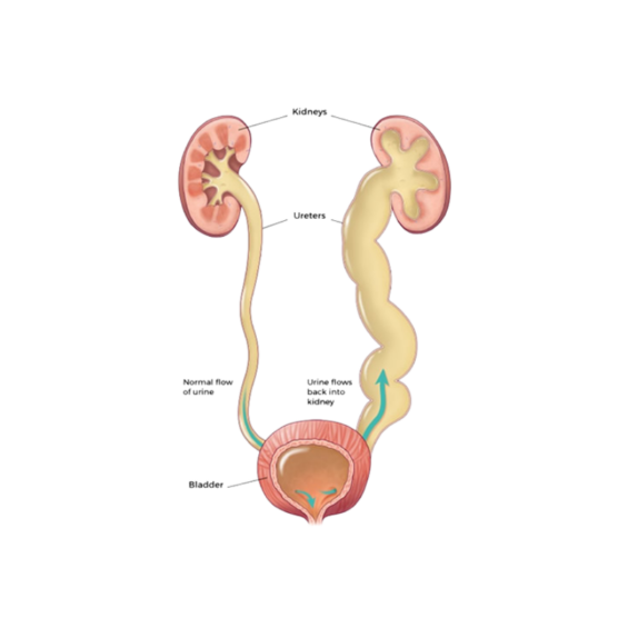 Vesicoureteral Reflux (VUR)