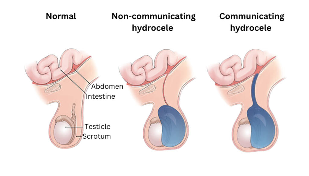 hydrocele types