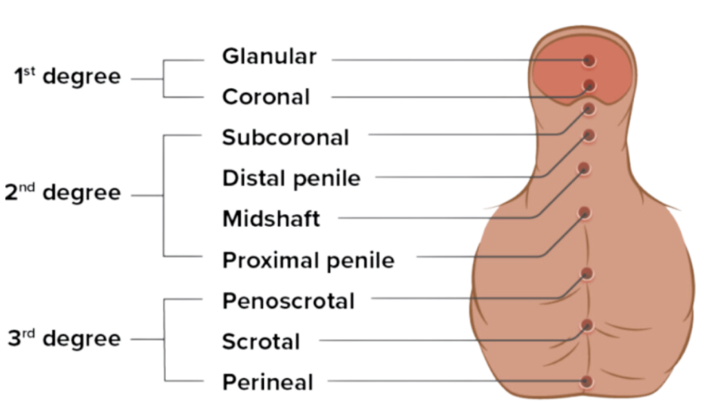 hypospediasis grades