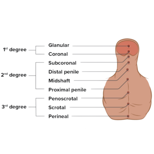 hypospediasis grades