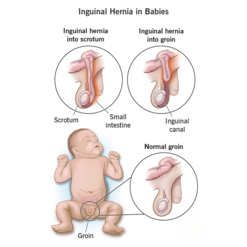 inguinal hernia