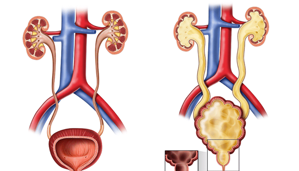 posterior-urethral-valves-illustration