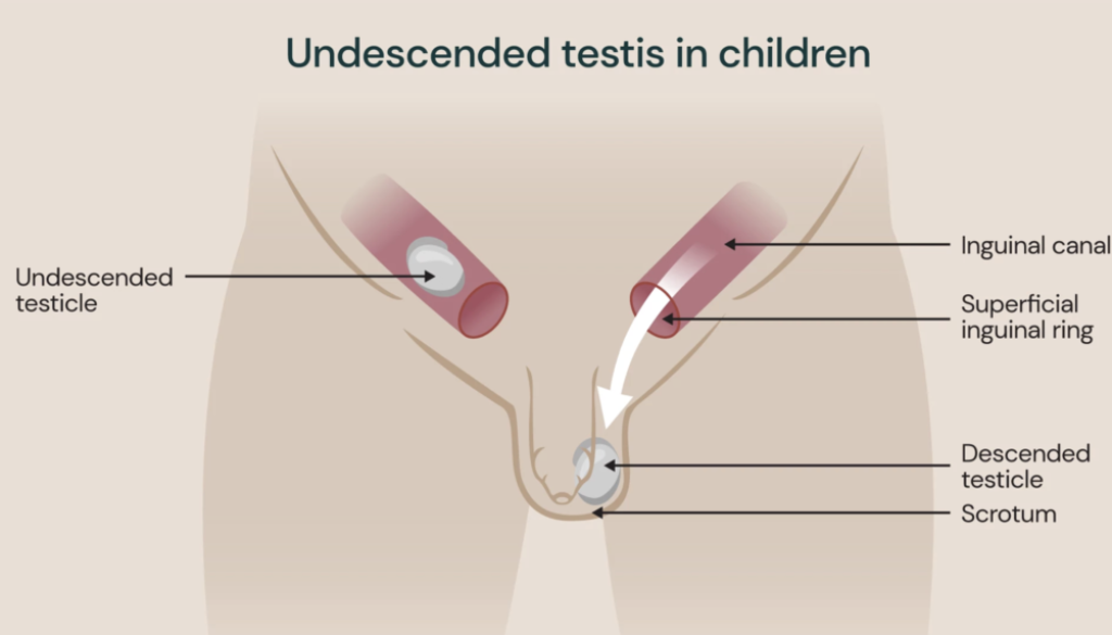 undescended testicle