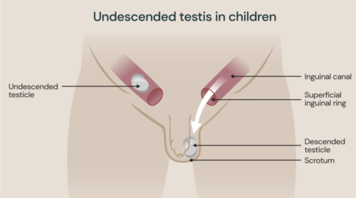 undescended testicle