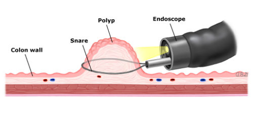 Polyp-removal