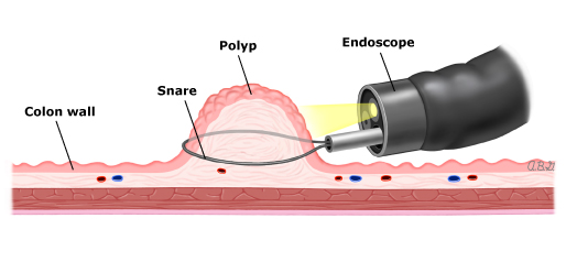 Polyp-removal