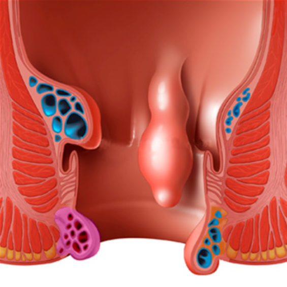 Rectal-Polyp