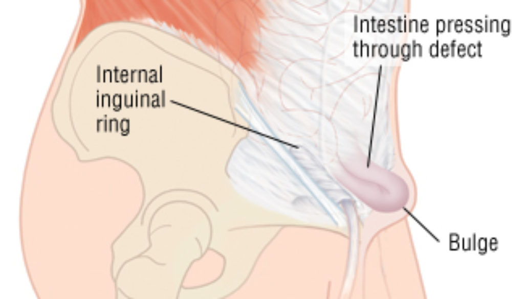 inguinal hernia