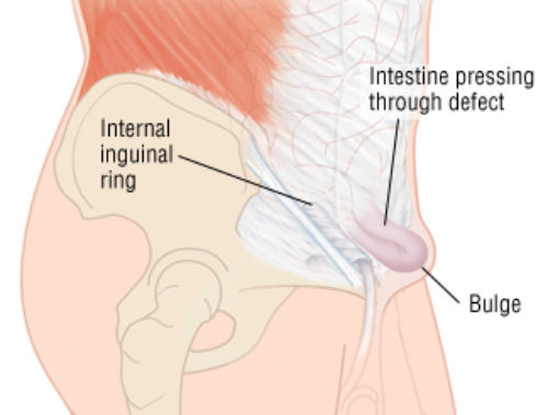 inguinal hernia