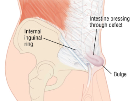 inguinal hernia